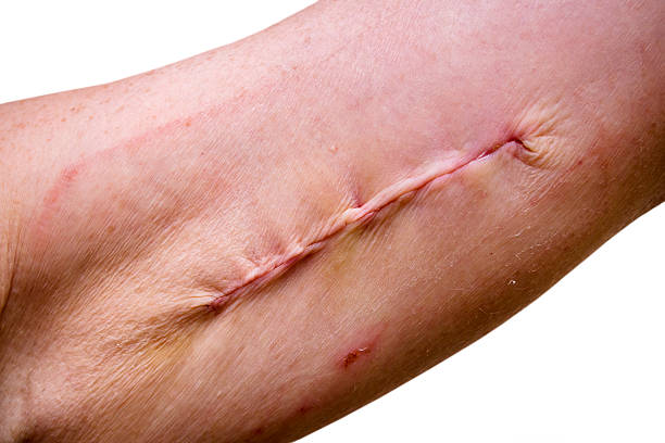 Scar management therapy session